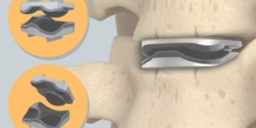 IPS marca un hito mundial al implantar tres discos cervicales artificiales en una misma cirugía