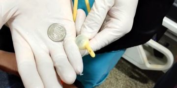 Exitoso procedimiento médico para extraer una moneda del esófago de un bebé